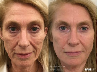 Cheekbone Filler Before & After Gallery - Patient 113313 - Image 1