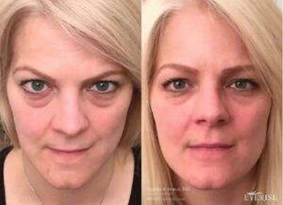 Eyerise™ Before & After Gallery - Patient 821556 - Image 1