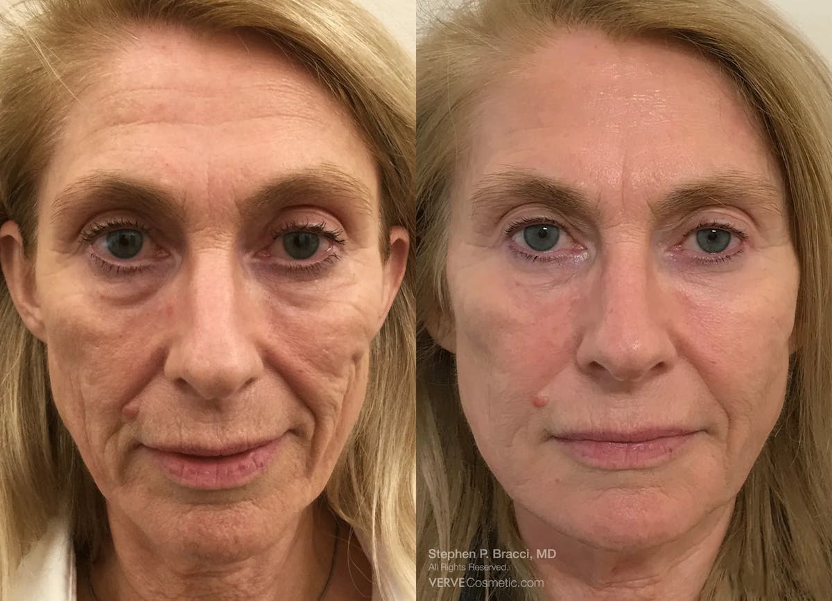 Eyerise™ Before & After Gallery - Patient 477811 - Image 1