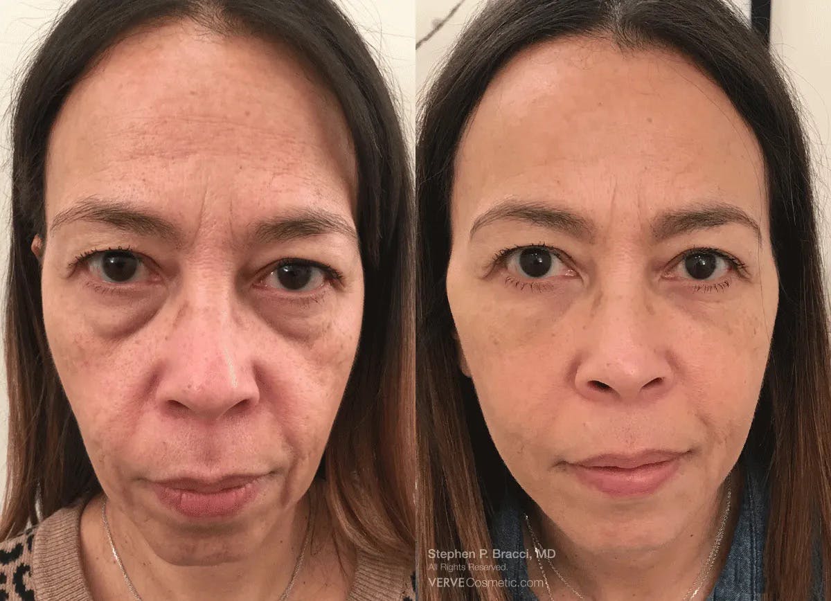 Eyerise™ Before & After Gallery - Patient 210448 - Image 1