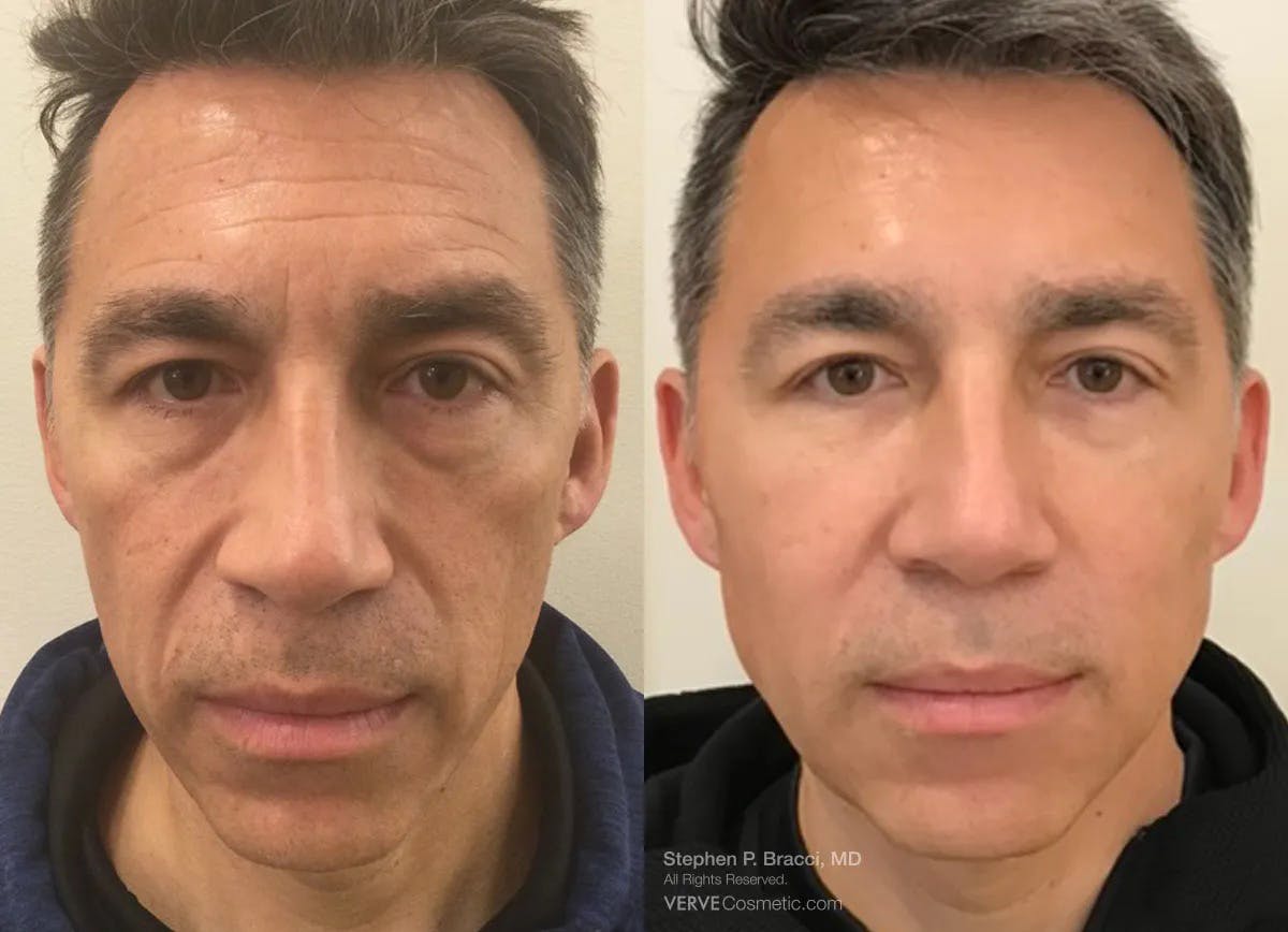 Eyerise™ Before & After Gallery - Patient 905313 - Image 1