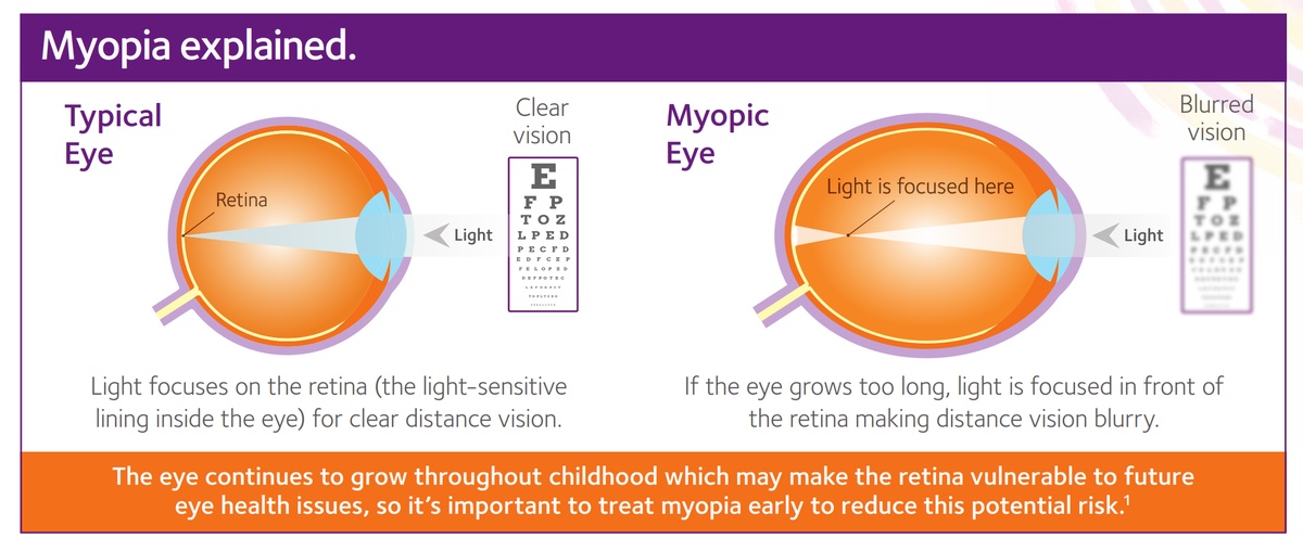 myopia graphic