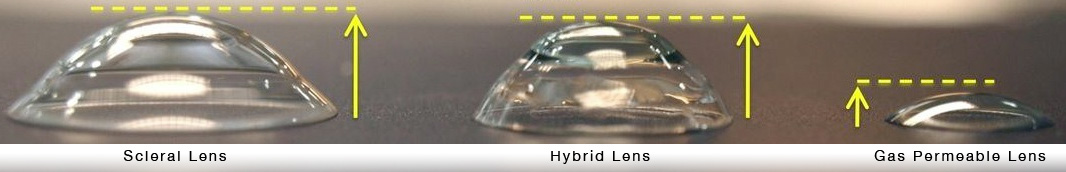 Scleral, hybrid, and gas permeable lens graphic