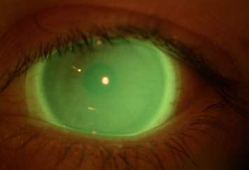 Scleral Lenses image