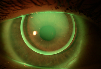 Rigid Gas Permeable Lenses image