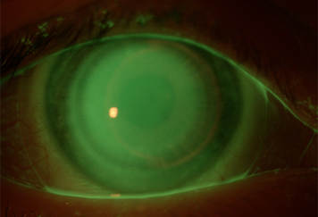 Hybrid Contact Lenses image