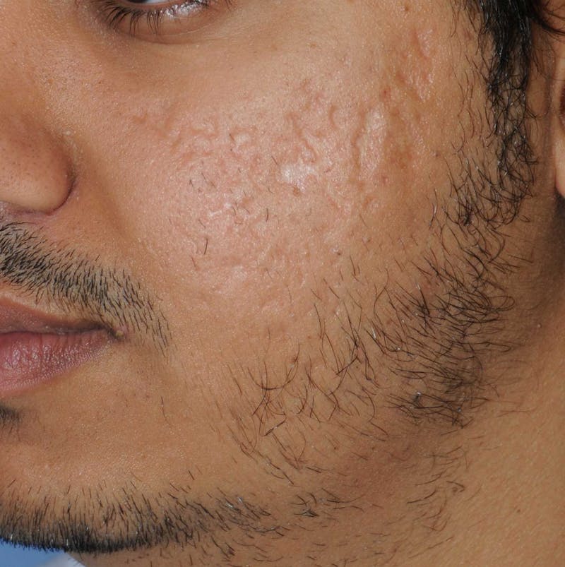 Acne Scar Treatment Before & After Gallery - Patient 186657 - Image 1