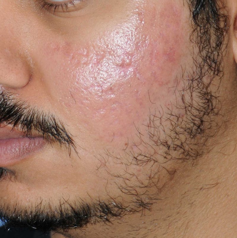 Acne Scar Treatment Before & After Gallery - Patient 186657 - Image 2