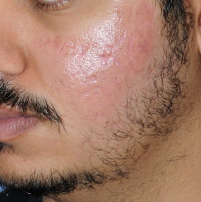 Acne Scar Treatment Before & After Gallery - Patient 186657 - Image 2
