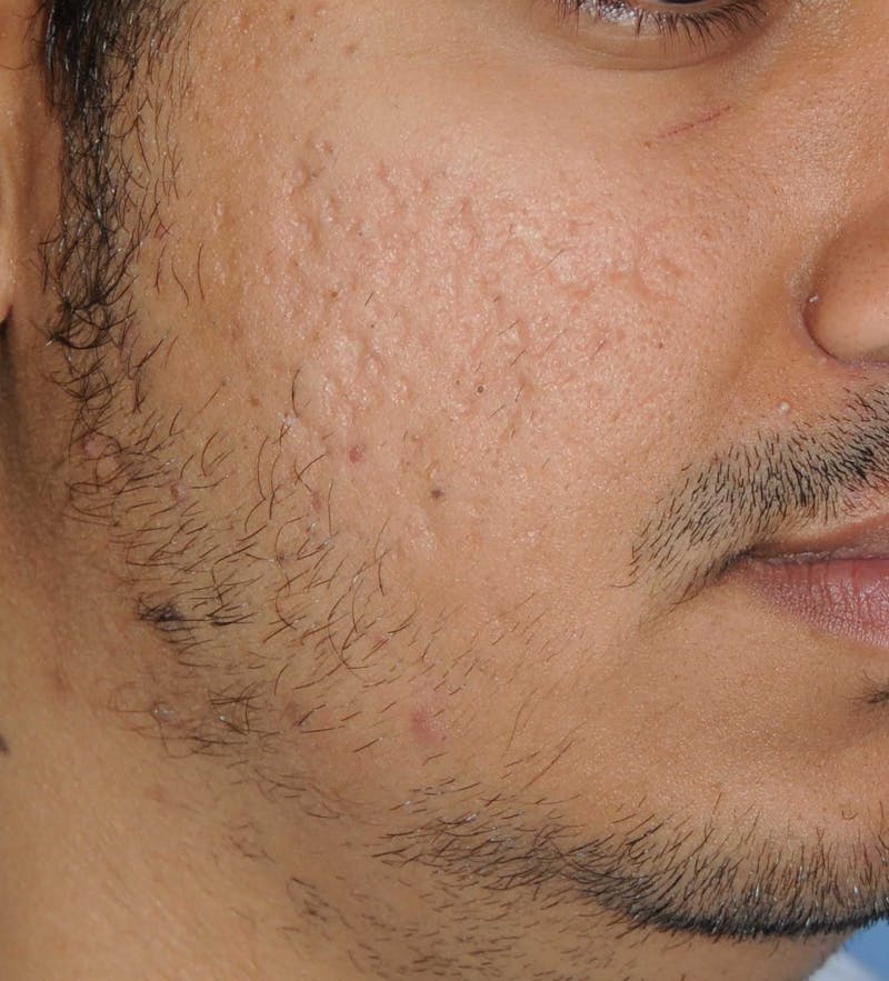 Acne Scar Treatment Before & After Gallery - Patient 186657 - Image 3