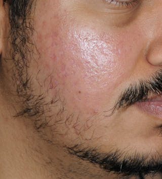 Acne Scar Treatment Before & After Gallery - Patient 186657 - Image 4