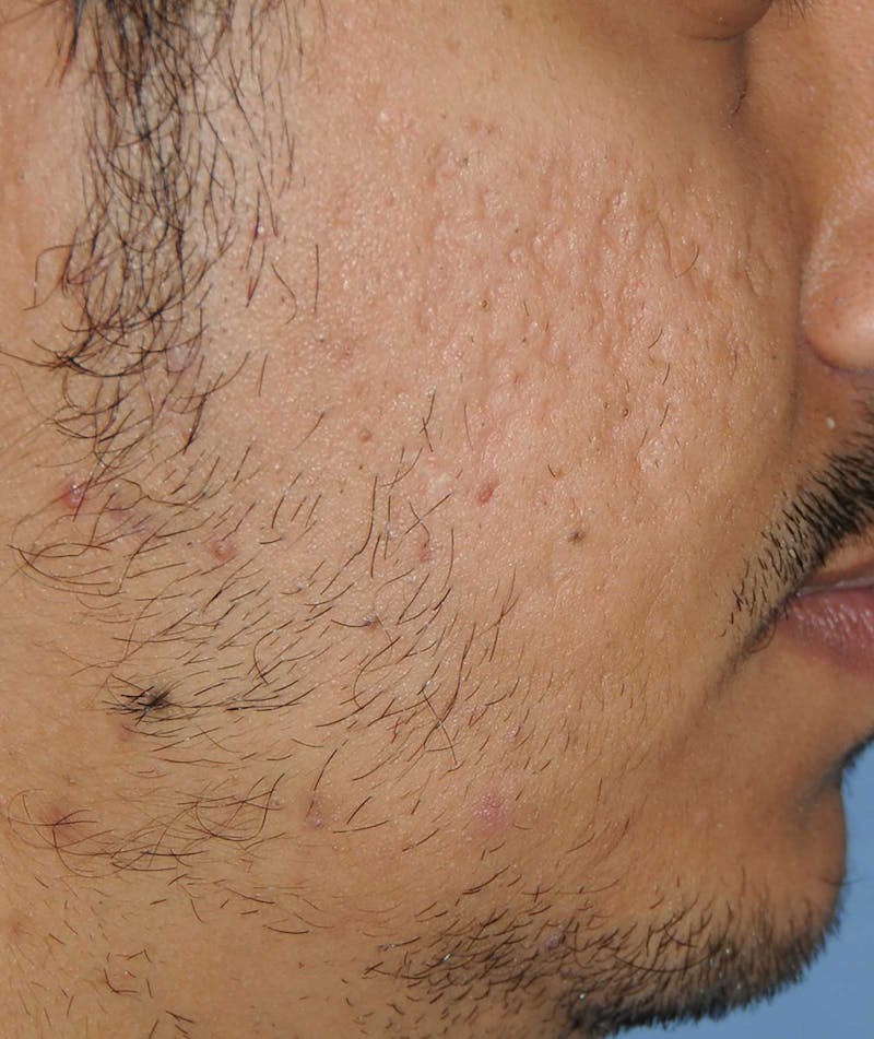 Acne Scar Treatment Before & After Gallery - Patient 186657 - Image 5