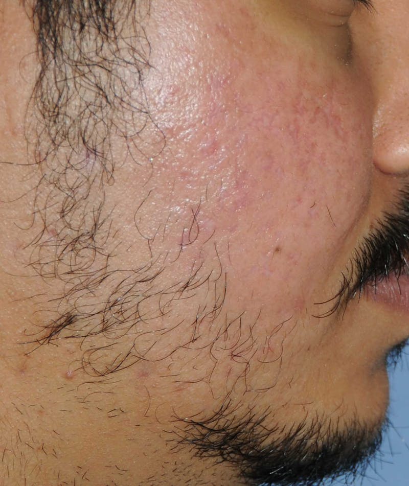 Acne Scar Treatment Before & After Gallery - Patient 186657 - Image 6