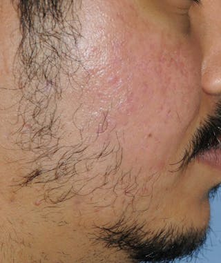 Acne Scar Treatment Before & After Gallery - Patient 186657 - Image 6