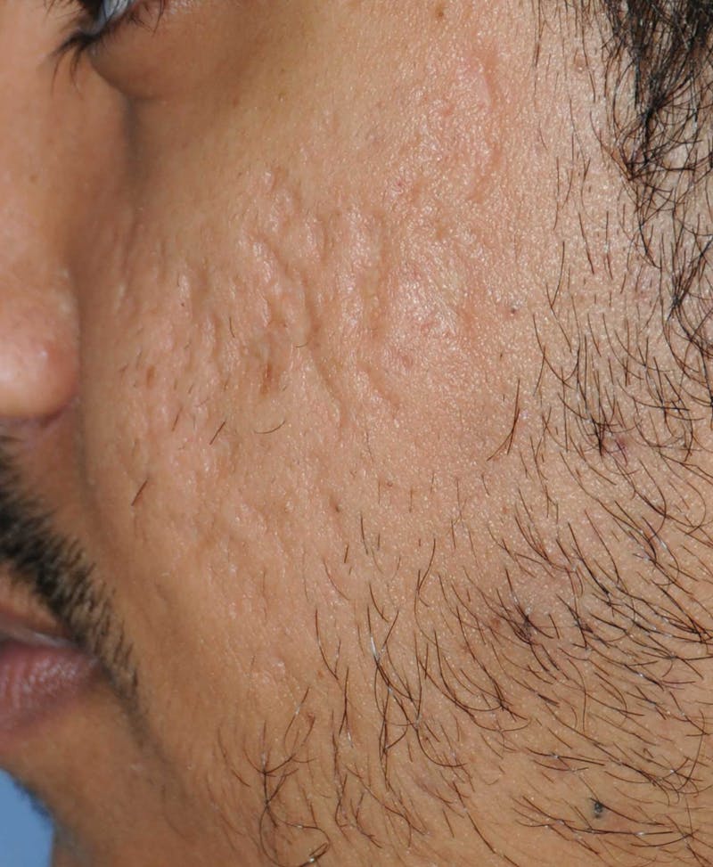 Acne Scar Treatment Before & After Gallery - Patient 186657 - Image 7