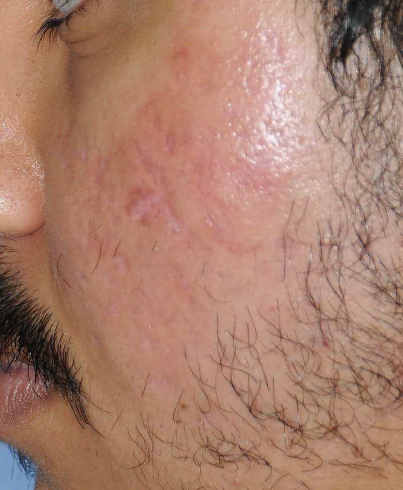 Acne Scar Treatment Before & After Gallery - Patient 186657 - Image 8