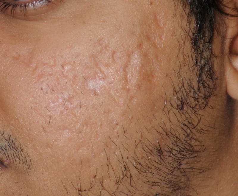 Acne Scar Treatment Before & After Gallery - Patient 186657 - Image 9