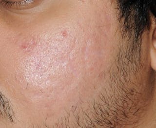 Acne Scar Treatment Before & After Gallery - Patient 186657 - Image 10