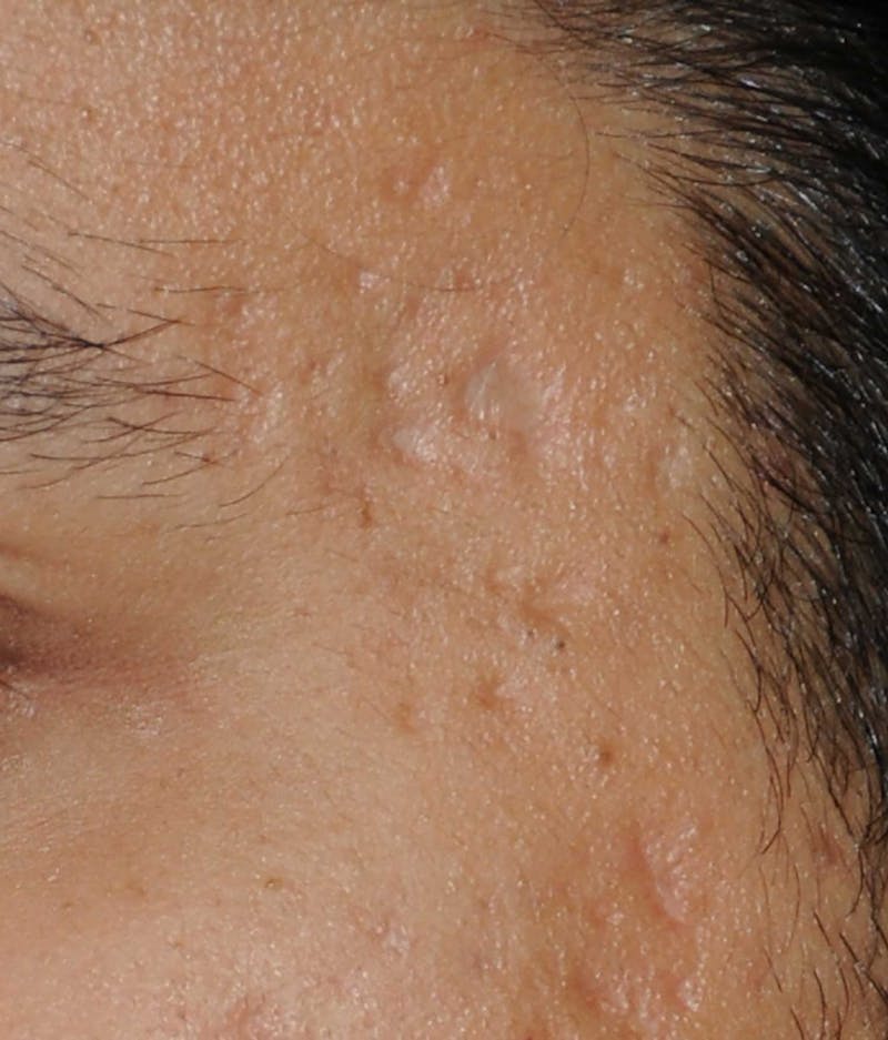 Acne Scar Treatment Before & After Gallery - Patient 186657 - Image 11