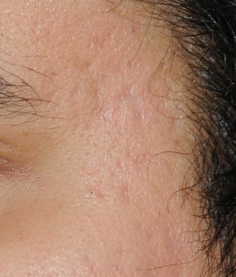 Acne Scar Treatment Before & After Gallery - Patient 186657 - Image 12