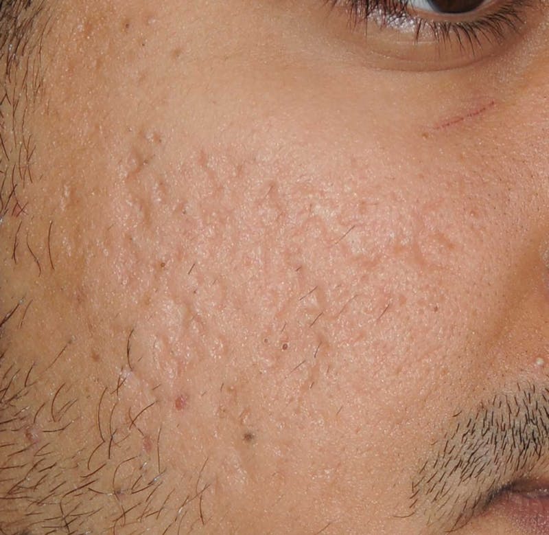 Acne Scar Treatment Before & After Gallery - Patient 186657 - Image 13