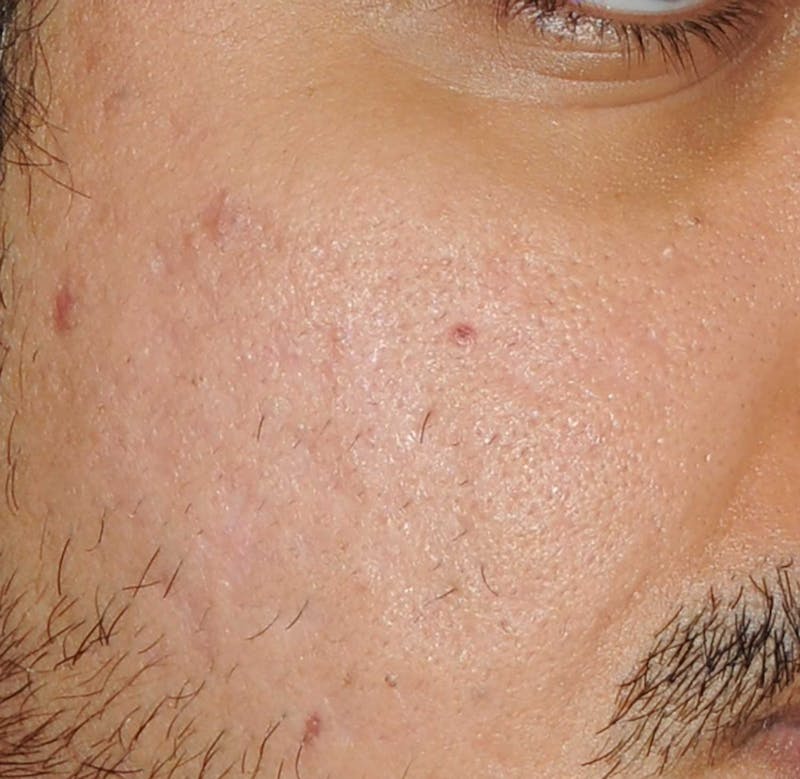 Acne Scar Treatment Before & After Gallery - Patient 186657 - Image 14