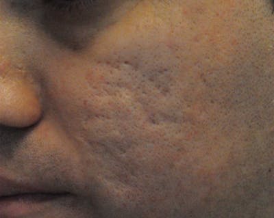 Acne Scar Treatment Before & After Gallery - Patient 172246 - Image 1