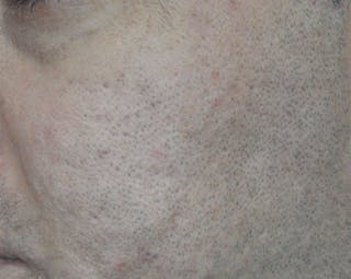 Acne Scar Treatment Before & After Gallery - Patient 172246 - Image 2