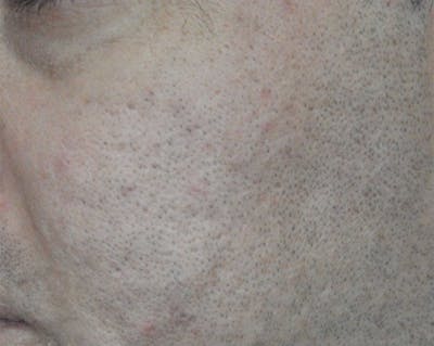 Acne Scar Treatment Before & After Gallery - Patient 172246 - Image 2