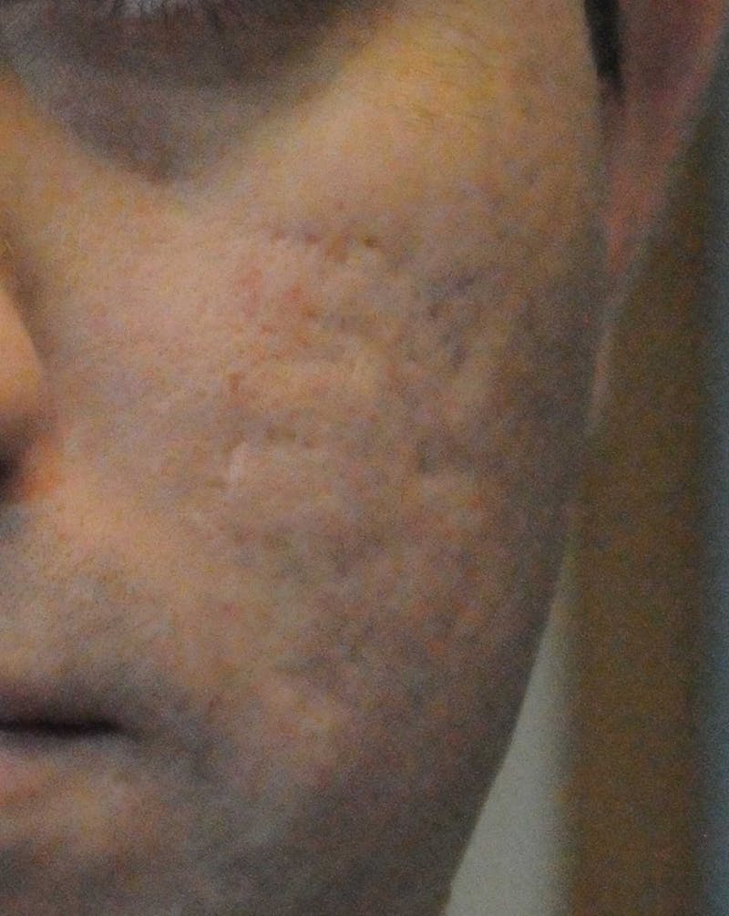 Acne Scar Treatment Before & After Gallery - Patient 172246 - Image 3