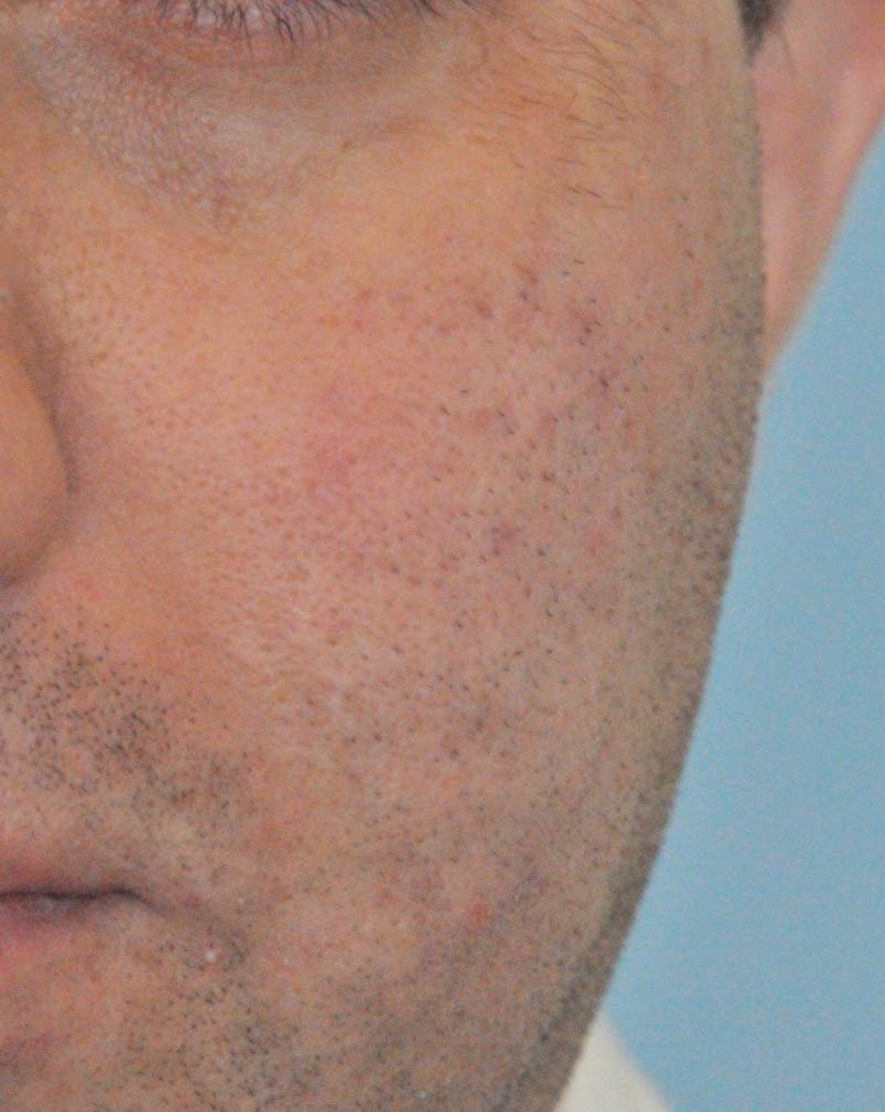 Acne Scar Treatment Before & After Gallery - Patient 172246 - Image 4