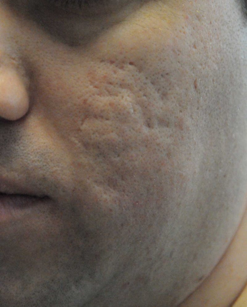 Acne Scar Treatment Before & After Gallery - Patient 172246 - Image 5