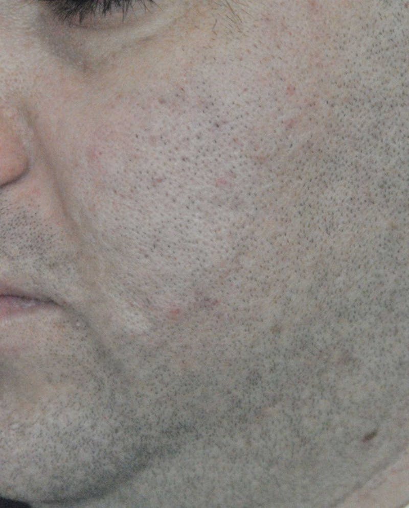 Acne Scar Treatment Before & After Gallery - Patient 172246 - Image 6