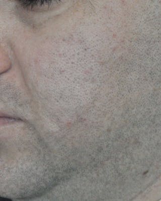 Acne Scar Treatment Before & After Gallery - Patient 172246 - Image 6