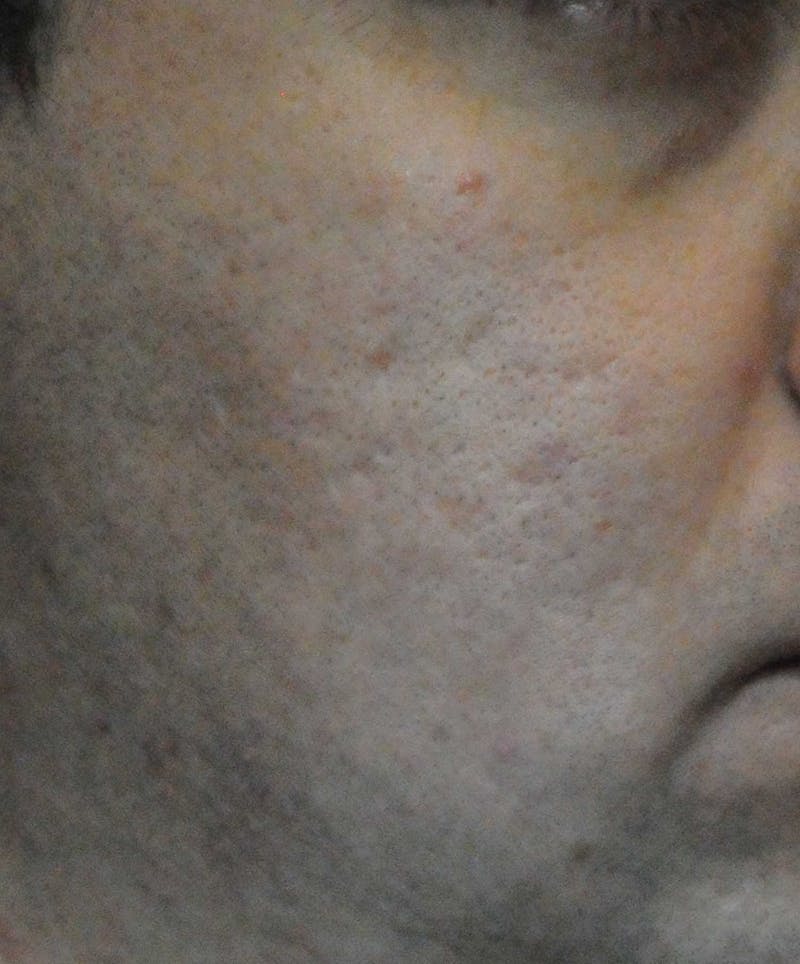 Acne Scar Treatment Before & After Gallery - Patient 172246 - Image 7