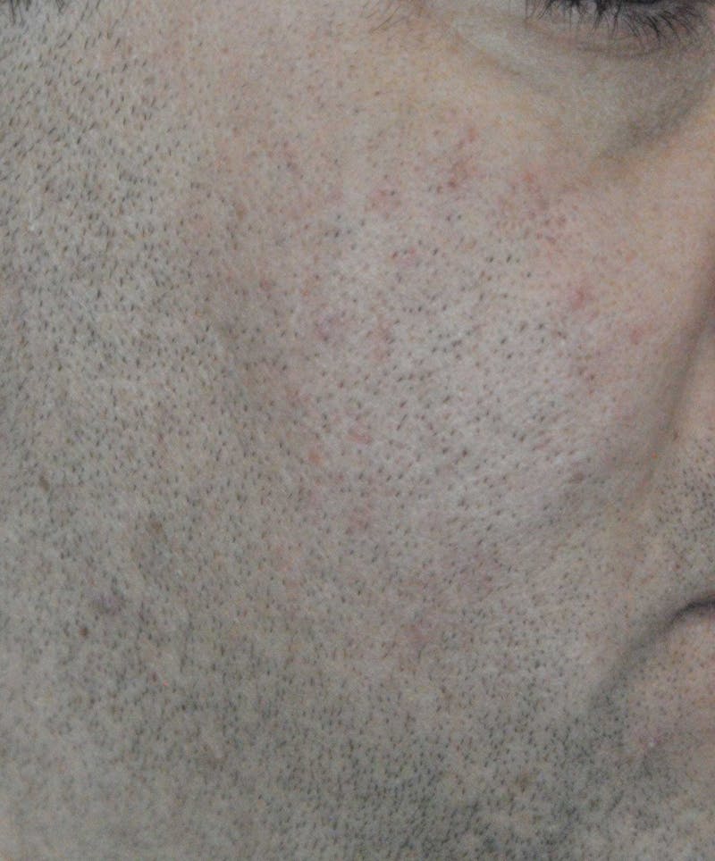 Acne Scar Treatment Before & After Gallery - Patient 172246 - Image 8
