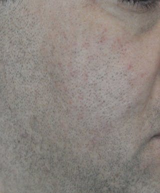 Acne Scar Treatment Before & After Gallery - Patient 172246 - Image 8