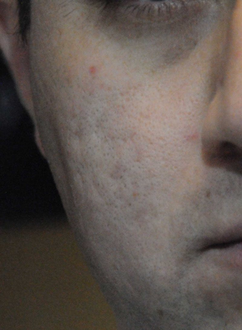 Acne Scar Treatment Before & After Gallery - Patient 172246 - Image 9
