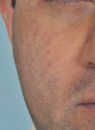 Acne Scar Treatment Before & After Gallery - Patient 172246 - Image 10