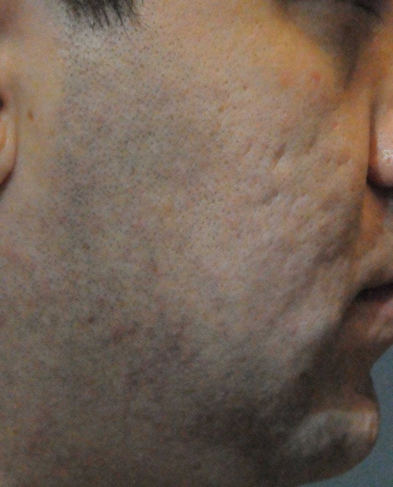 Acne Scar Treatment Before & After Gallery - Patient 172246 - Image 11
