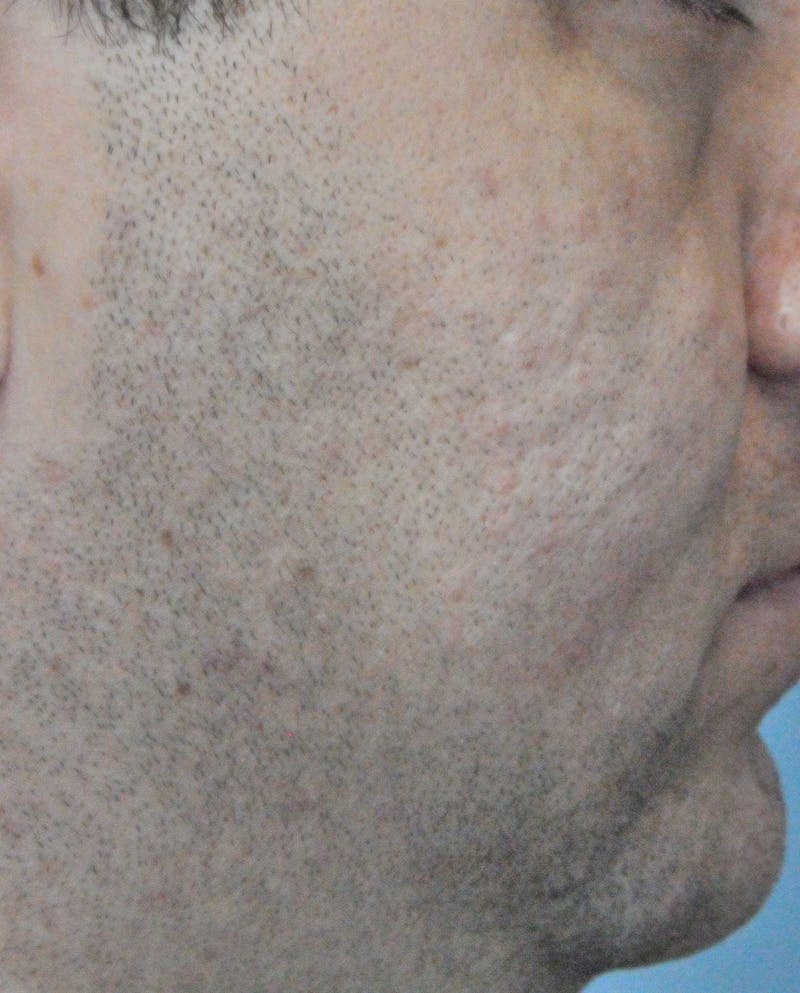 Acne Scar Treatment Before & After Gallery - Patient 172246 - Image 12