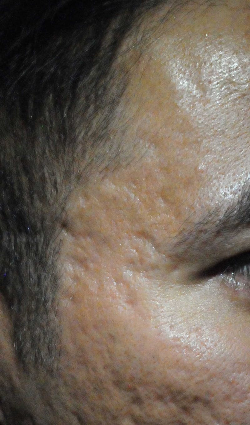 Acne Scar Treatment Before & After Gallery - Patient 250389 - Image 1