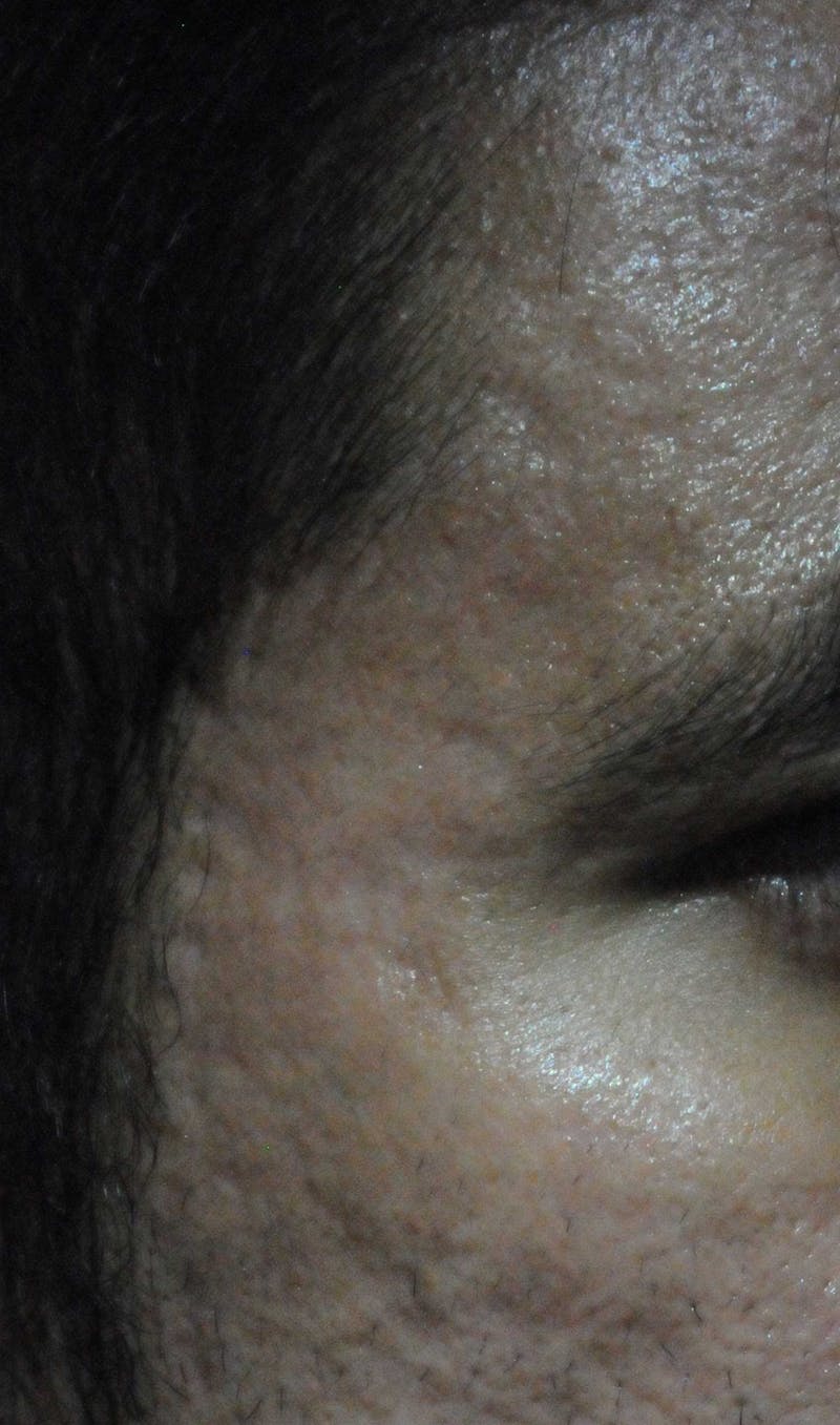 Acne Scar Treatment Before & After Gallery - Patient 250389 - Image 2