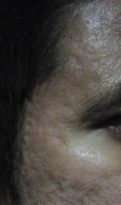 Acne Scar Treatment Before & After Gallery - Patient 250389 - Image 2