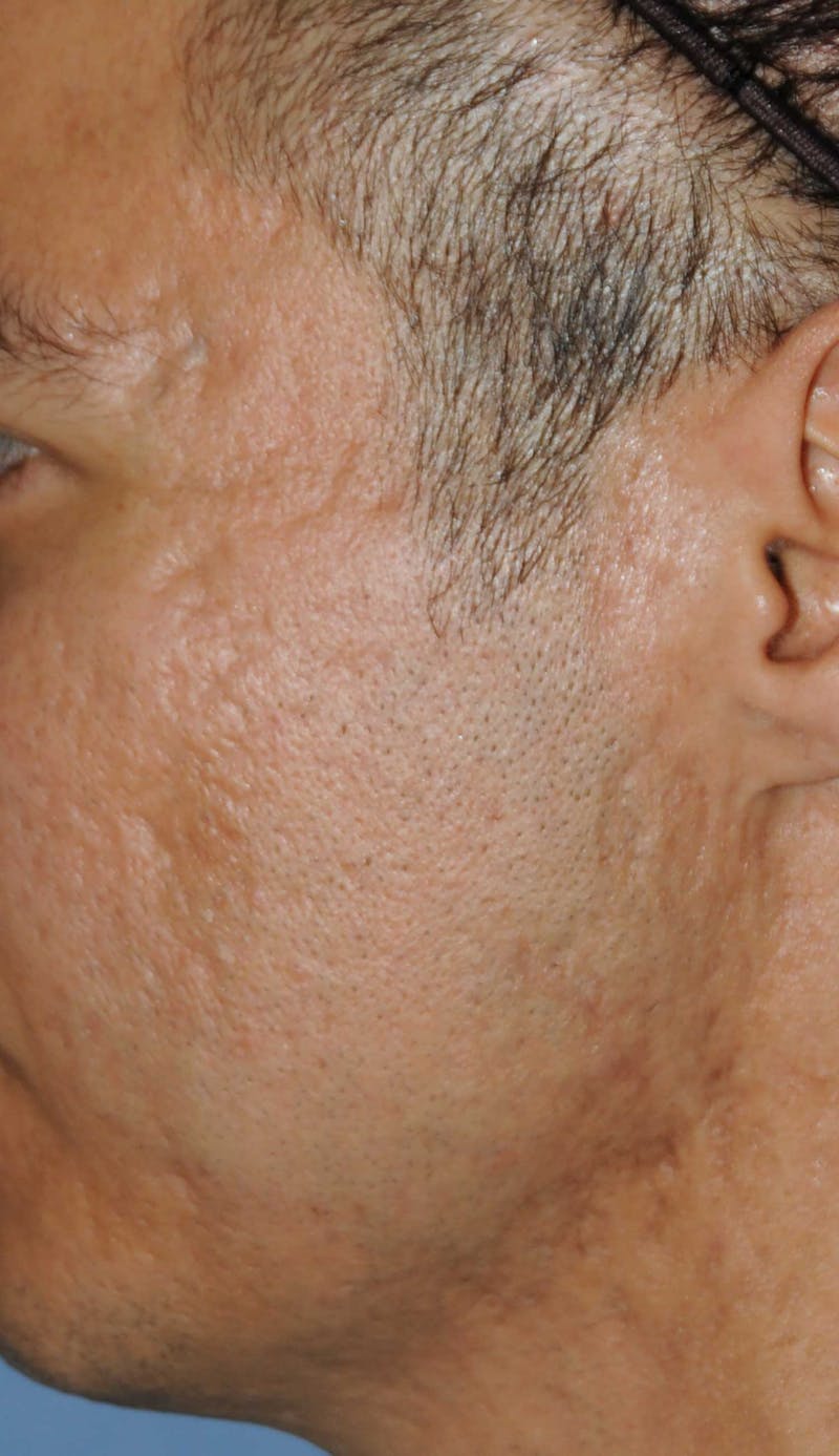 Acne Scar Treatment Before & After Gallery - Patient 250389 - Image 3