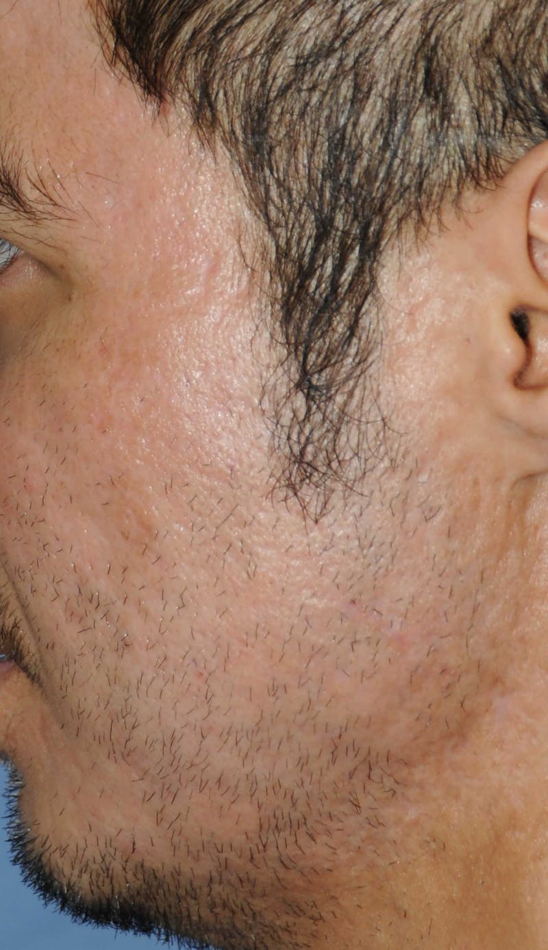 Acne Scar Treatment Before & After Gallery - Patient 250389 - Image 4