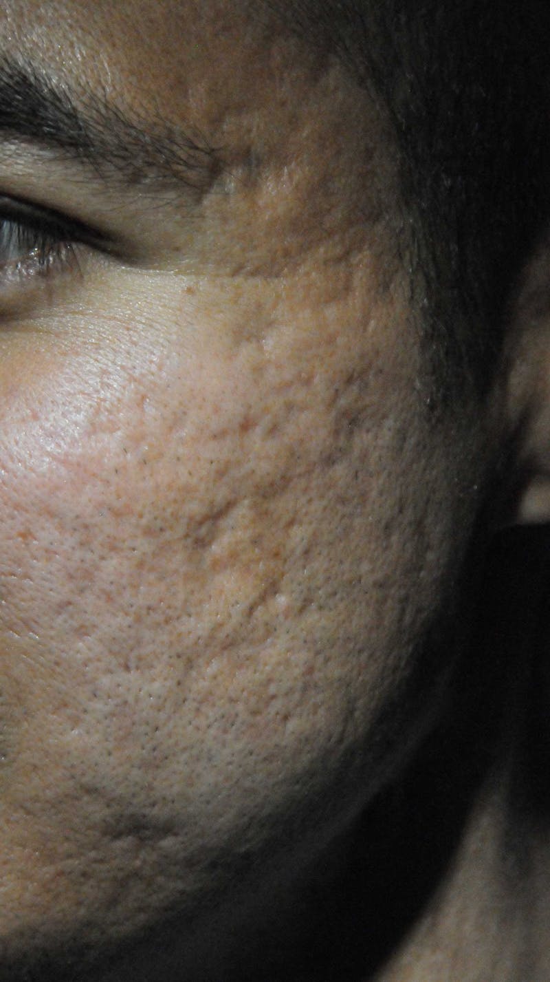 Acne Scar Treatment Before & After Gallery - Patient 250389 - Image 5