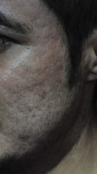 Acne Scar Treatment Before & After Gallery - Patient 250389 - Image 6