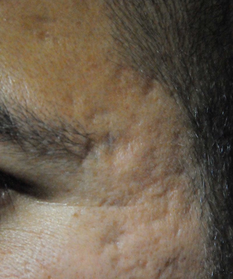 Acne Scar Treatment Before & After Gallery - Patient 250389 - Image 7