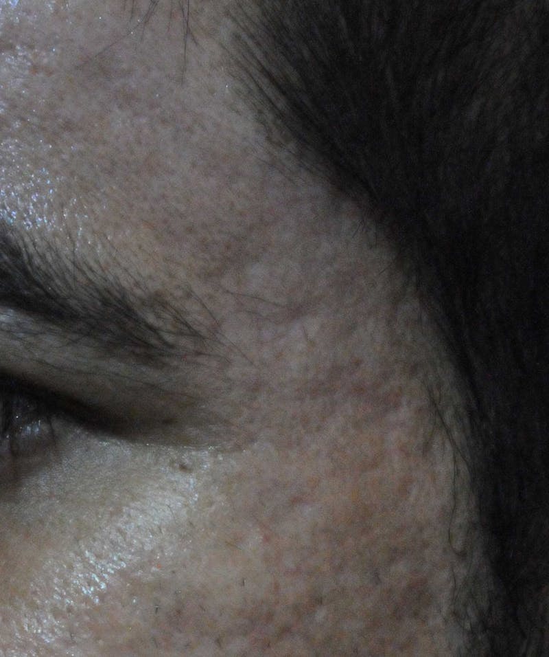 Acne Scar Treatment Before & After Gallery - Patient 250389 - Image 8